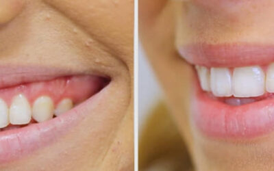 Д-р Елена Котакова за приложението на ботулиновия токсин (ботокс) в денталната медицина и автотрансплантацията на зъби