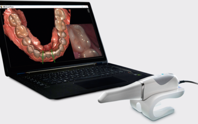 Преносим CS 3600 3D Scanner – бързо и гъвкаво интраорално сканиране