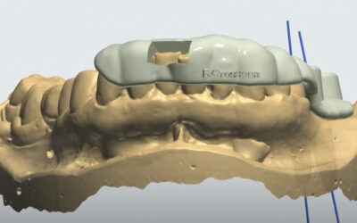 3D водено поставяне на импланти – представяне на клиничен случай с тригодишно проследяване