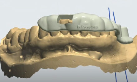 3D водено поставяне на импланти – представяне на клиничен случай с тригодишно проследяване