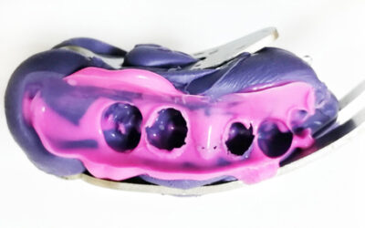 Модифициран метод за отпечатък в неподвижното протезиране