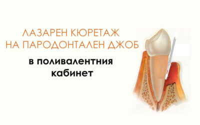 Каква е специфичната техника при провеждане на лазерен кюретаж на пародонтални джобове? – Статия + Видео