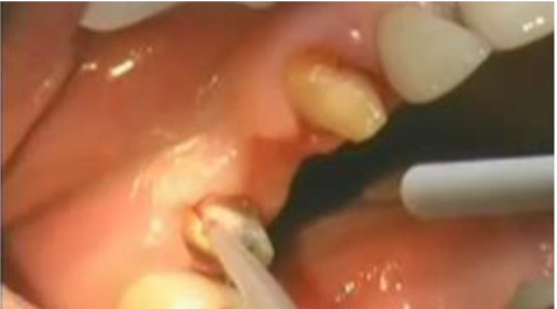 Обучение и подържане на дентални диодни лазери