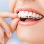 Представяме нашите безцветни алайнери – Clear Smile от Infinity Dental Lab Bulgaria + Видео
